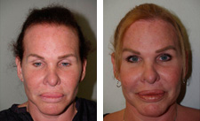 Before and after one procedure of 3,900 grafts