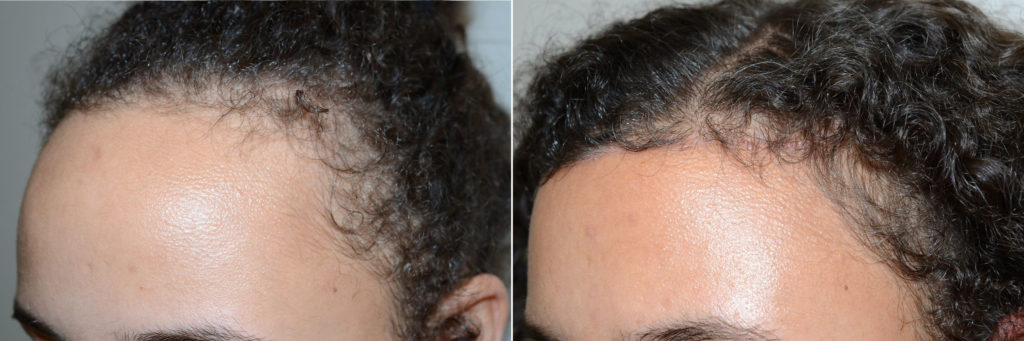 Before and 6 months after hairline lowering surgery oblicue view