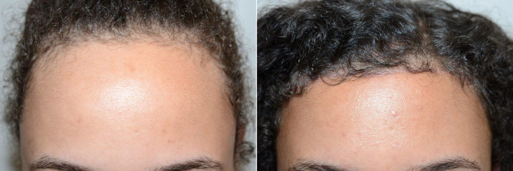 Before and 6 months after hairline lowering surgery