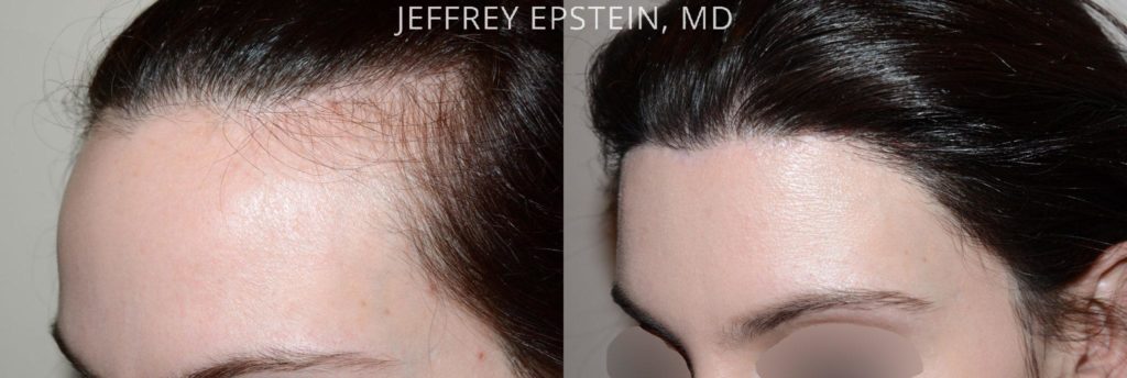 Antes y después de la reducción de la línea del cabello / acortamiento de la frente de la cirugía oblicue vista