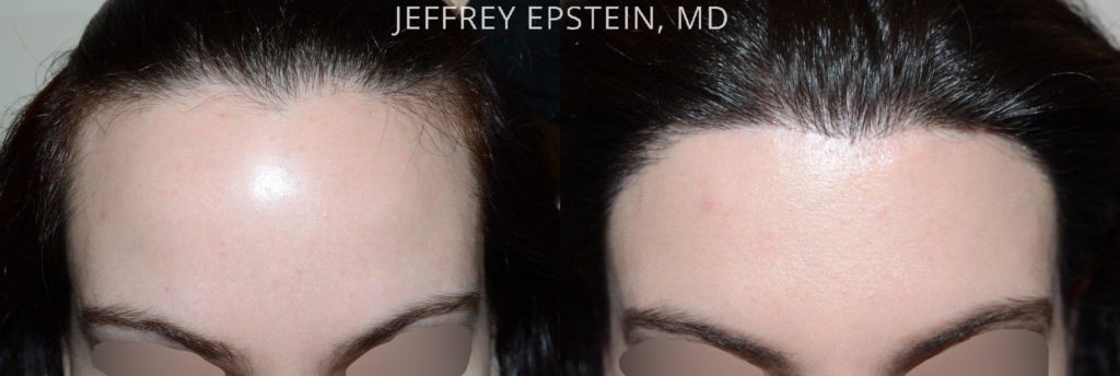 Antes y después de la cirugía de reducción de la línea del cabello/acortamiento de la frente