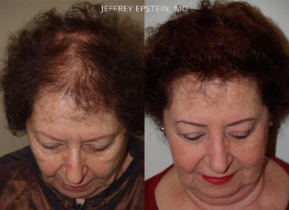 Mujer Reemplazo de cabello vista frontal después y después de la foto paciente 2