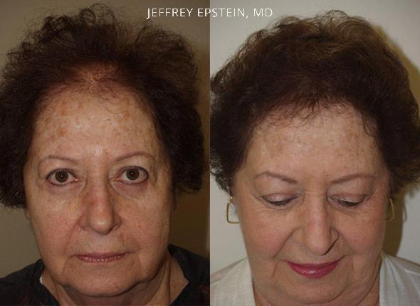 Mujer Reemplazo de cabello vista frontal antes y después de la foto paciente 2