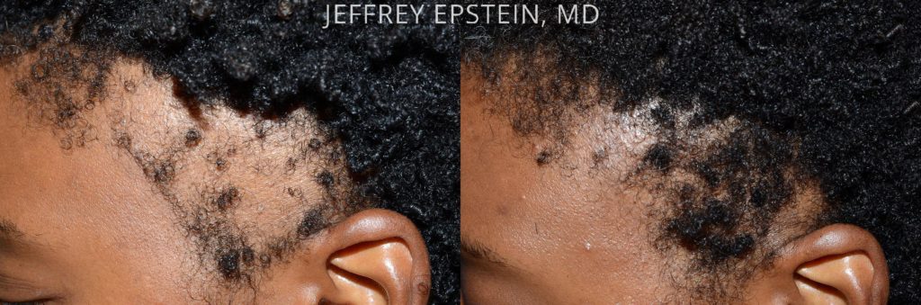 Antes y después de la mujer reemplazo de cabello lateral izquierda antes y después de ver al paciente 7