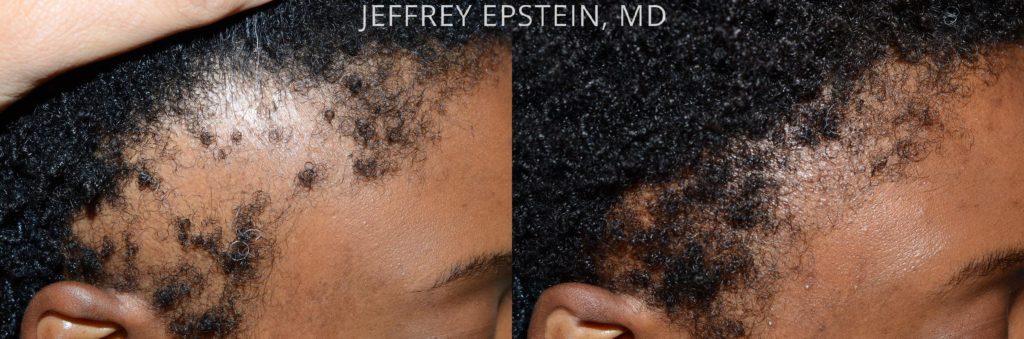 Antes y después del reemplazo de cabello lateral de la mujer antes y después de ver al paciente 7
