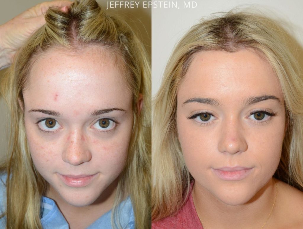 Mujer Reemplazo de cabello vista frontal antes y después de la foto paciente 1
