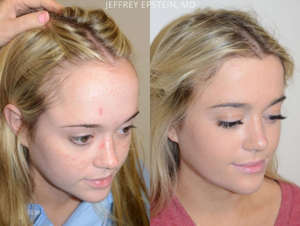 Mujer Reemplazo de cabello vista frontal después y después de la foto paciente 1