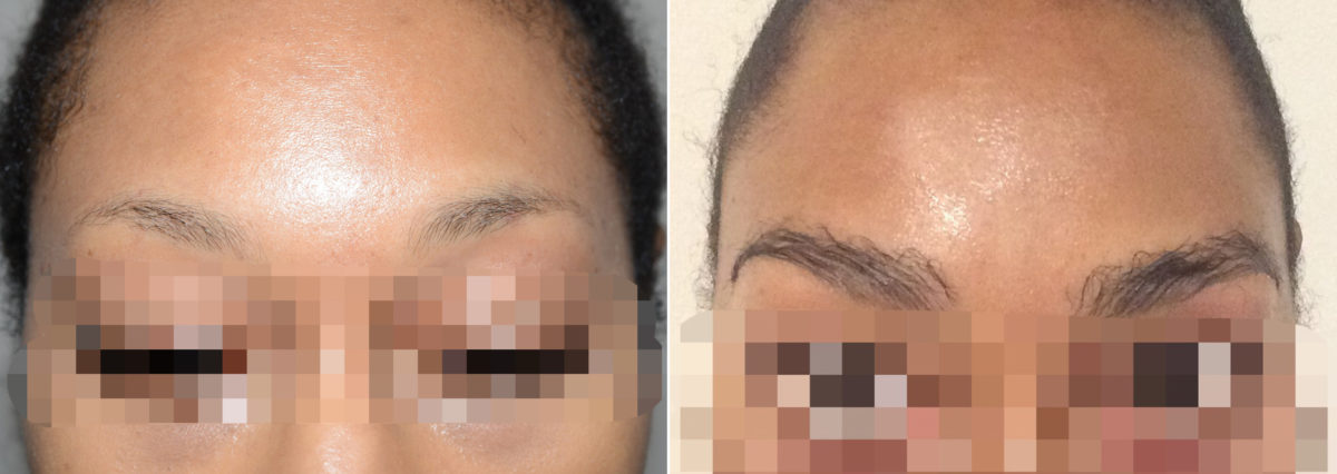 Eyebrow Hair Transplant Before and after in Miami, FL, Paciente 110760
