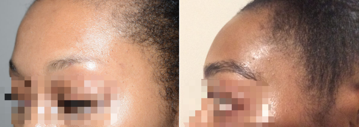 Eyebrow Hair Transplant Before and after in Miami, FL, Paciente 110760