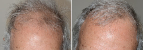 Body Hair Transplant Before and after in Miami, FL, Paciente 110780