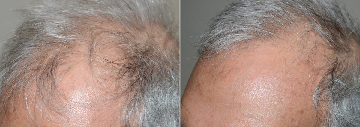 Body Hair Before and after in Miami, FL, Paciente 110780