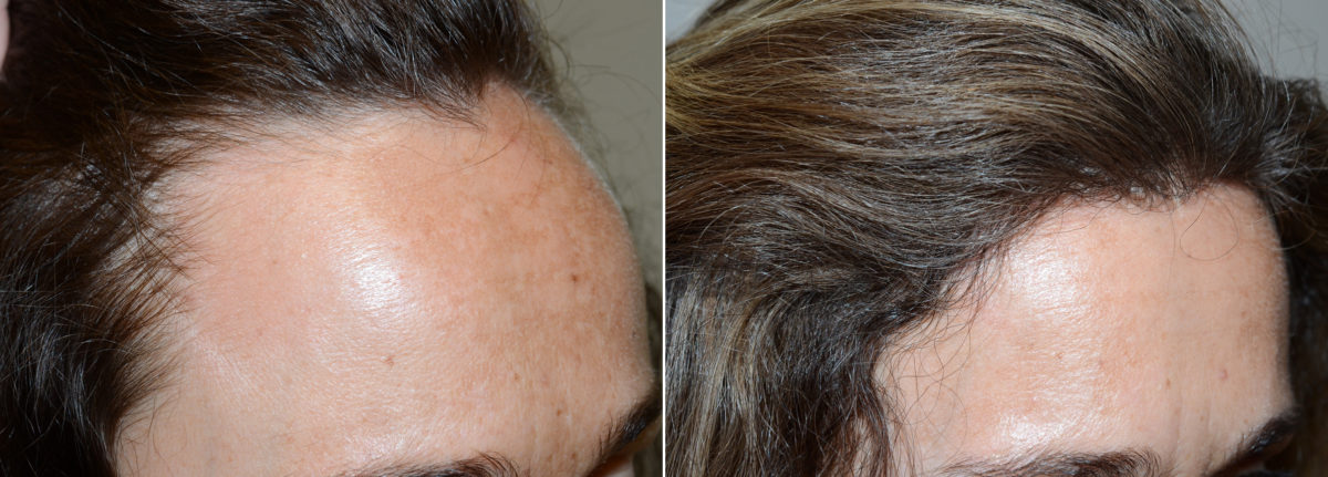 Hairline Advancement Before and after in Miami, FL, Paciente 110582