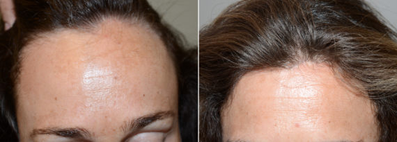 Forehead Reduction Surgery Before and after in Miami, FL, Paciente 110582