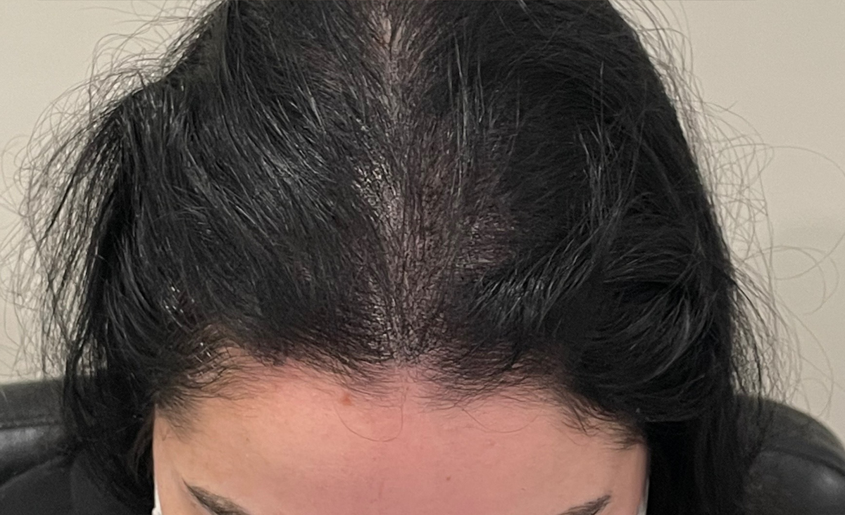 Micropigmentación del cuero cabelludo después de la imagen de la vista superior de la mujer