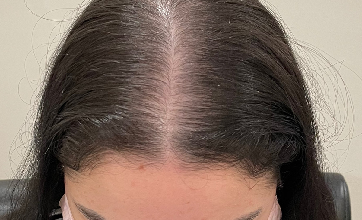 Micropigmentación del cuero cabelludo antes de la imagen de la vista superior de la mujer