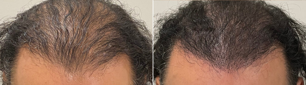 Scalp Micropigmentation Before and after in Miami, FL, Paciente 110931