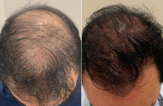 Scalp Micropigmentation Before and after in Miami, FL, Paciente 108036