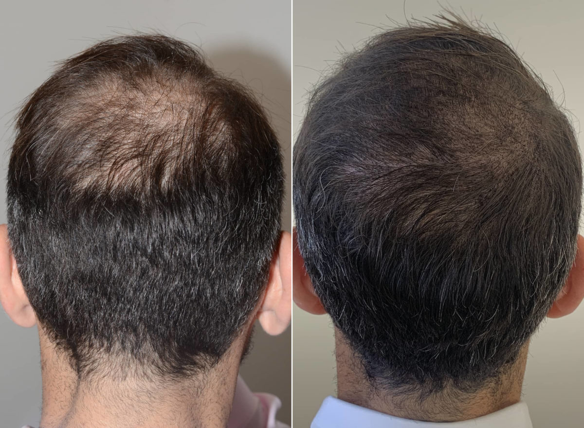 Scalp Micropigmentation Before and after in Miami, FL, Paciente 108058