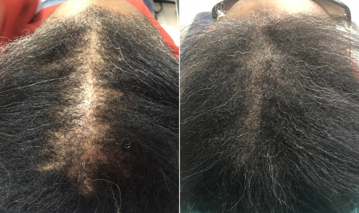 Scalp Micropigmentation Before and after in Miami, FL, Paciente 108066