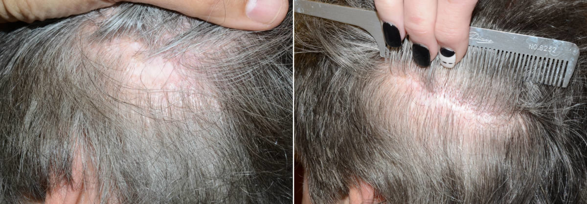 Reparative Hair Transplant Before and after in Miami, FL, Paciente 108200