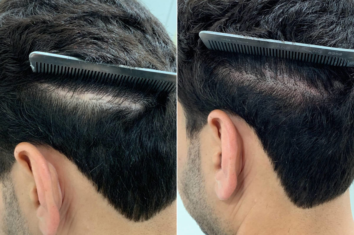 Reparative Hair Transplant Before and after in Miami, FL, Paciente 108218