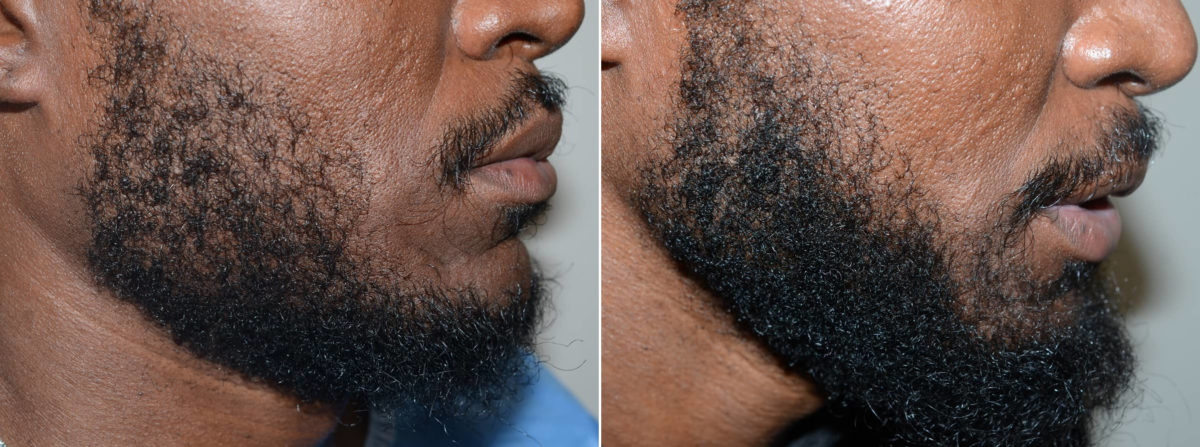 Facial Hair Transplant Before and after in Miami, FL, Paciente 108316