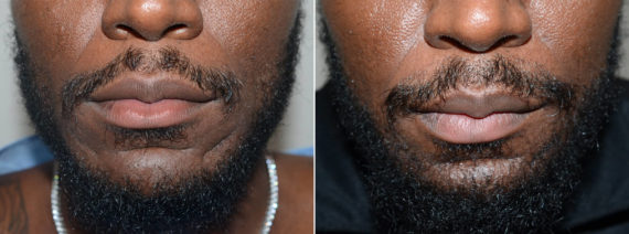 Facial Hair Before and after in Miami, FL, Paciente 108316
