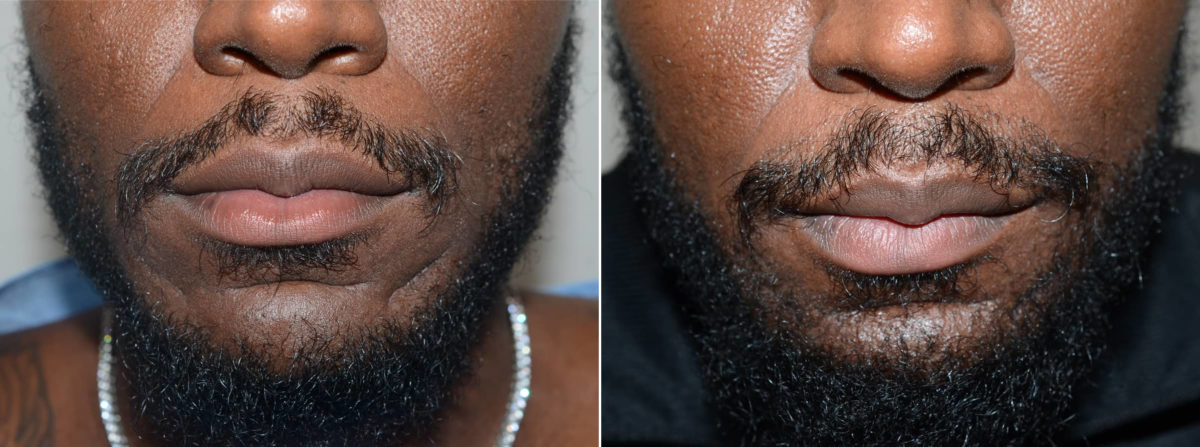 Trasplante de Pelo Facial Antes y después en Miami, FL, Paciente 108329