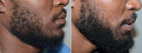 Trasplante de Pelo Facial Before and after in Miami, FL, Paciente 108329
