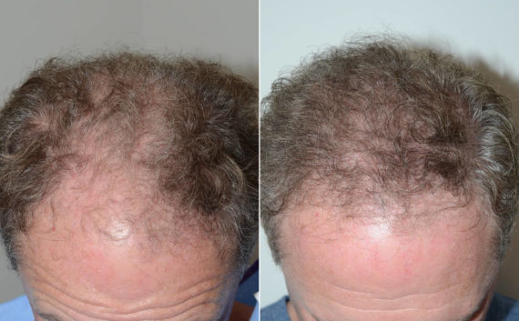Hair Transplants for Men Before and after in Miami, FL, Paciente 108657