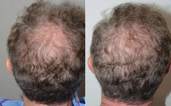 Trasplante de Pelo en Hombres Before and after in Miami, FL, Paciente 108675