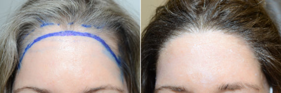 Hair Transplants for Women Before and after in Miami, FL, Paciente 112493