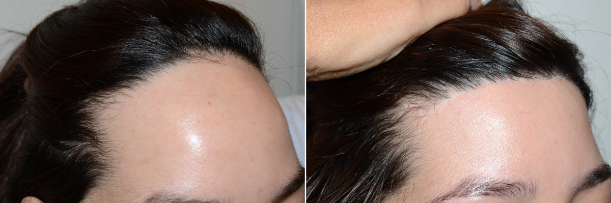 Hairline Advancement Before and after in Miami, FL, Paciente 112515