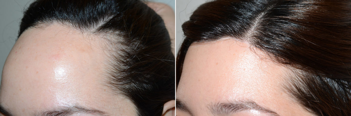 Hairline Advancement Before and after in Miami, FL, Paciente 112515
