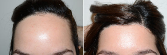 Forehead Reduction Surgery Before and after in Miami, FL, Paciente 112515