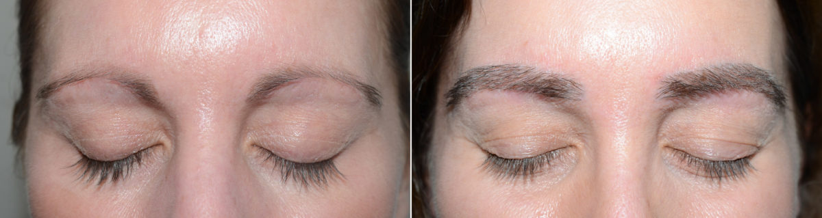 Eyebrow Before and after in Miami, FL, Paciente 112570