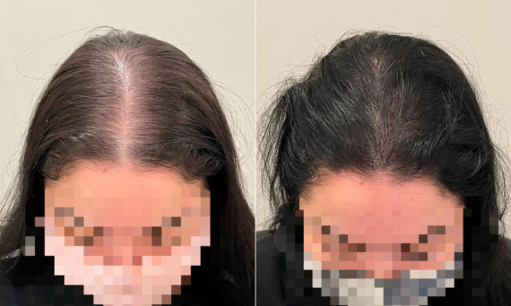 Micropigmentación Capilar Before and after in Miami, FL, Paciente 113021