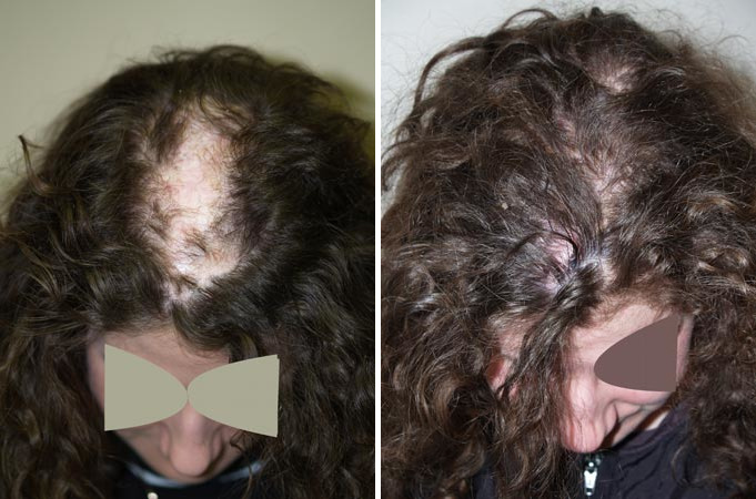 Hair Transplants for Women Before and after in Miami, FL, Paciente 41732