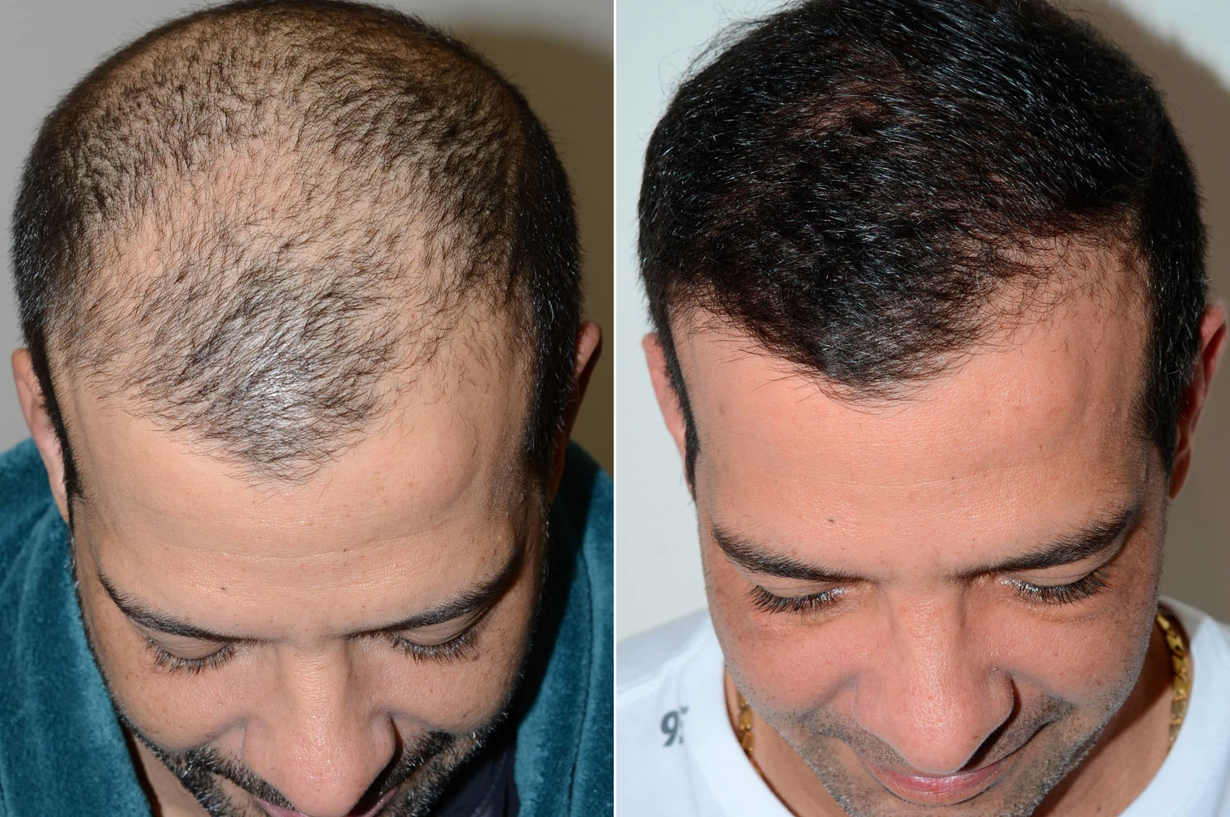 Пересадка волос воронеж. Пересадка волос фото до и после.
