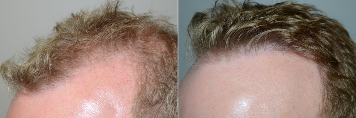 Hair Transplants for Men Before and after in Miami, FL, Paciente 59016