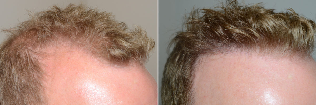 Hair Transplants for Men Before and after in Miami, FL, Paciente 59016