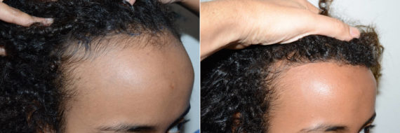 Hair Transplants for Women Before and after in Miami, FL, Paciente 60004