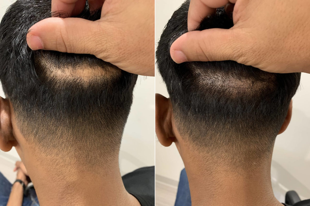 Scalp Micropigmentation Before and after in Miami, FL, Paciente 60020