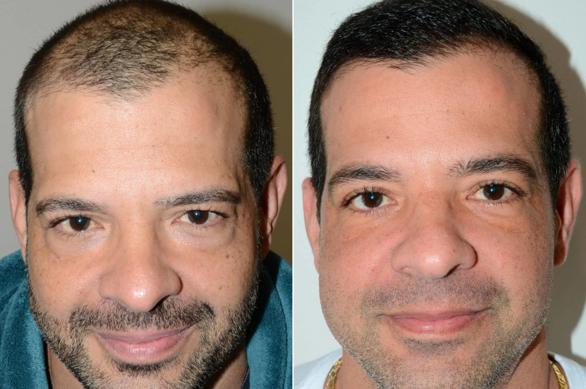 Trasplante de Pelo en Hombres Antes y después en Miami, FL, Paciente 74291