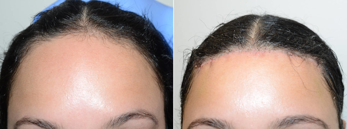 Hair Transplants for Women Before and after in Miami, FL, Paciente 117260
