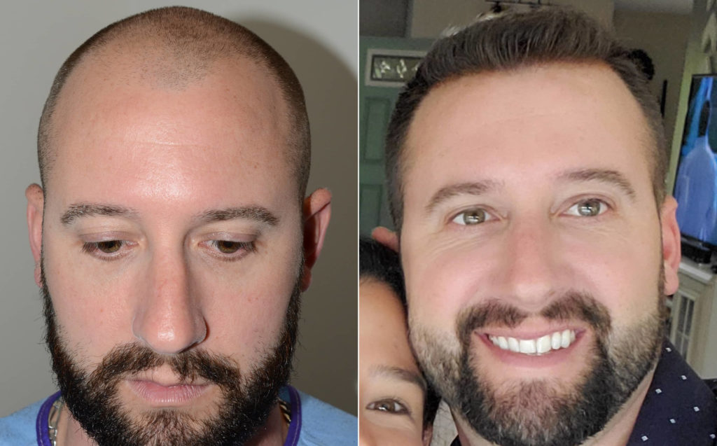Antes y Después -Vista frontal completa