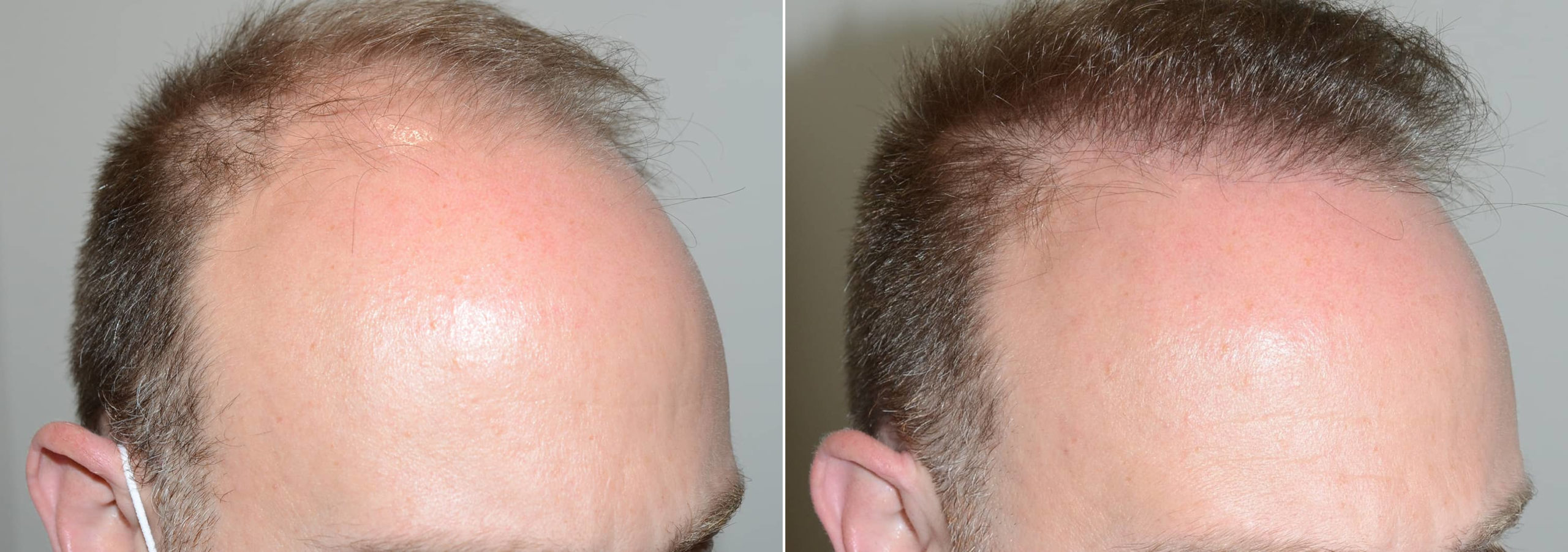 Hair Transplants For Men Pictures Miami Fl Paciente 117344