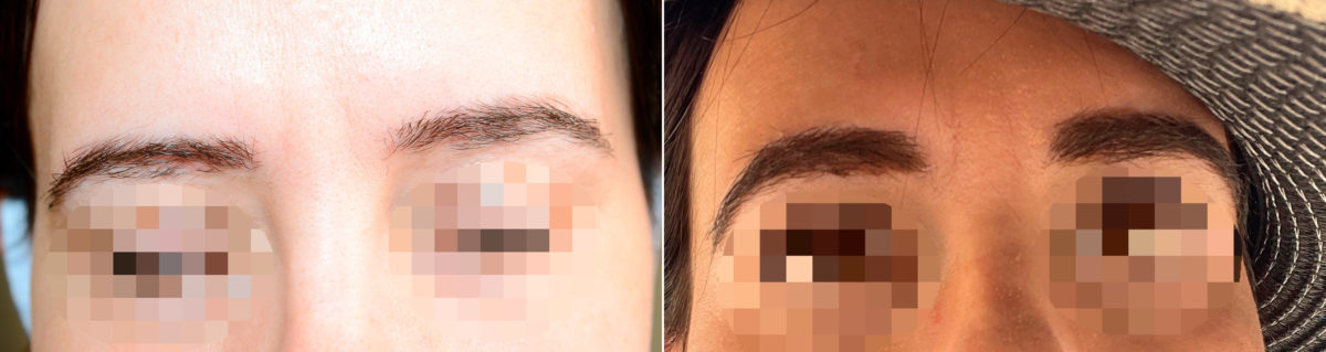 Eyebrow Hair Transplant Before and after in Miami, FL, Paciente 117451