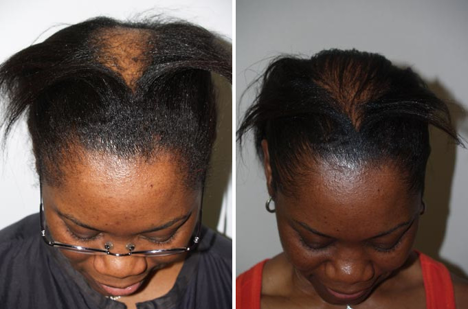 Hair Transplants for Women Before and after in Miami, FL, Paciente 41489