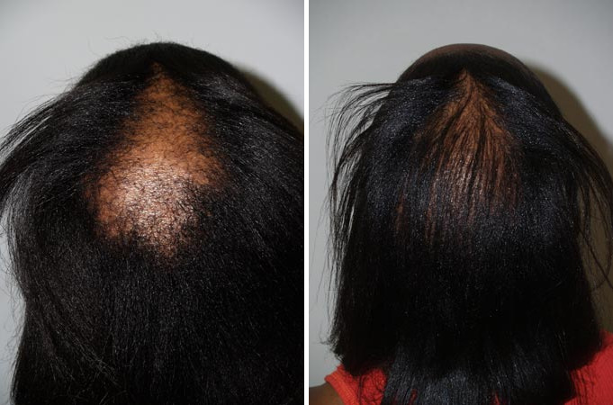 Hair Transplants for Women Before and after in Miami, FL, Paciente 41489